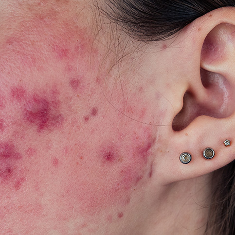 example of severe acne