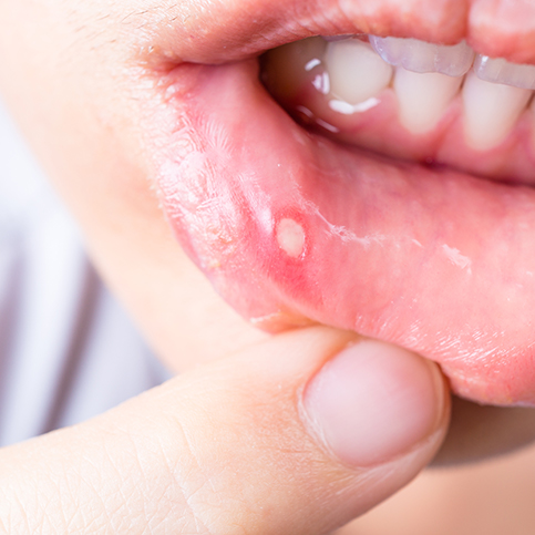 finding canker sore on lip